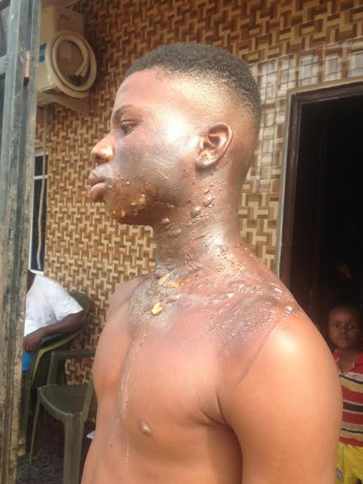 16-year-old burnt by kerosene explosion in Nsukka, Enugu State