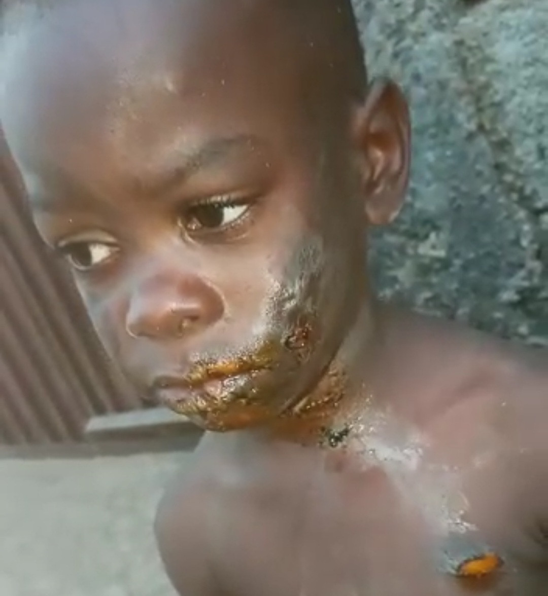 How aunt left boy with serious burns in Imo state