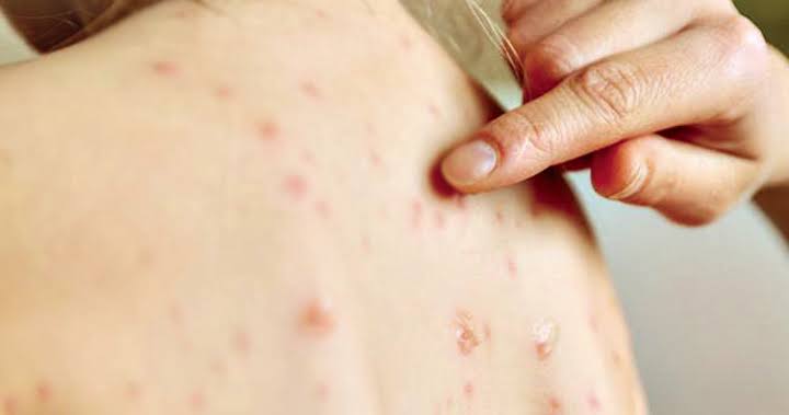 UK calls for immediate action over measles outbreak in the state