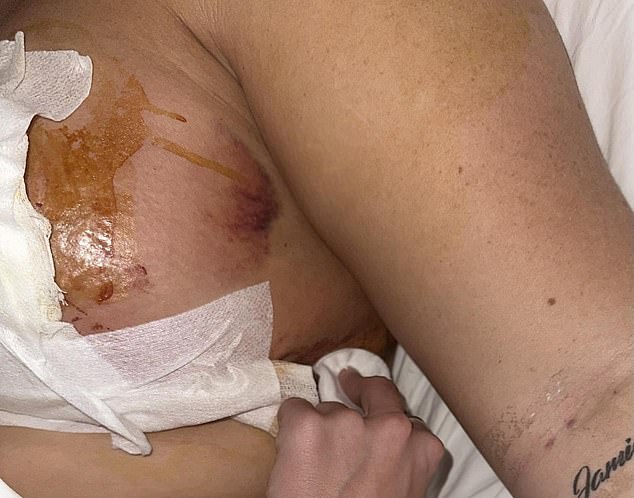 Breast upliftment surgery gone wrong as 22-year-old woman
