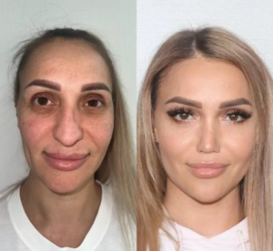 extensive face surgery