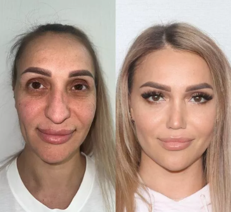 extensive face surgery